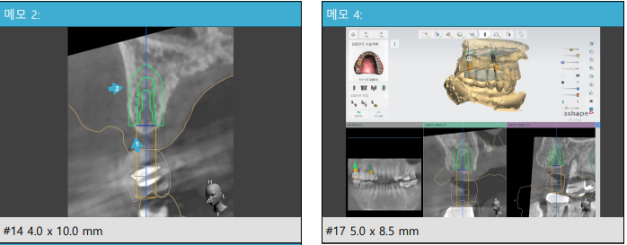 Shindang Implant: Should I get one or not? (Advanced Bone Graft Implant Duration and Pain) 사진 3