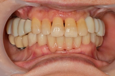 Shindang Implant: Should I get one or not? (Advanced Bone Graft Implant Duration and Pain) 사진 12