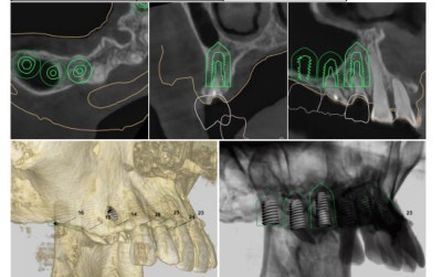 Shindang Implant: Should I get one or not? (Advanced Bone Graft Implant Duration and Pain) 사진 8