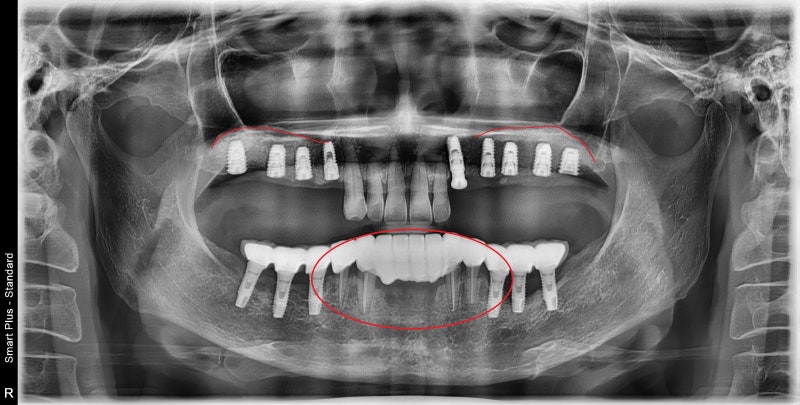 Shindang Implant: Should I get one or not? (Advanced Bone Graft Implant Duration and Pain) 사진 10