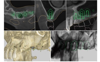 Shindang Implant: Should I get one or not? (Advanced Bone Graft Implant Duration and Pain) 사진 7