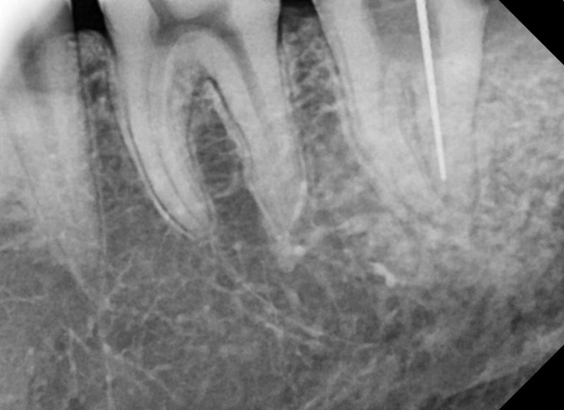 Dokter Gigi Stasiun Dongdae-ipgu, Apakah Gusi Akan Bengkak dan Berbau Jika Gigi Bungsu Impaksi Dibiarkan? (Gingivitis, K
