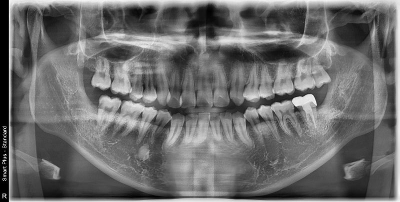 Dokter Gigi Stasiun Dongdae-ipgu, Apakah Gusi Akan Bengkak dan Berbau Jika Gigi Bungsu Impaksi Dibiarkan? (Gingivitis, K