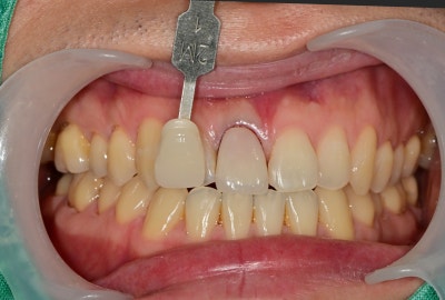 Shingeumho Station Dental Clinic: Concerned about an old, darkened front tooth crown? 사진 6