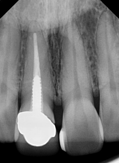 Shingeumho Station Dental Clinic: Concerned about an old, darkened front tooth crown? 사진 3