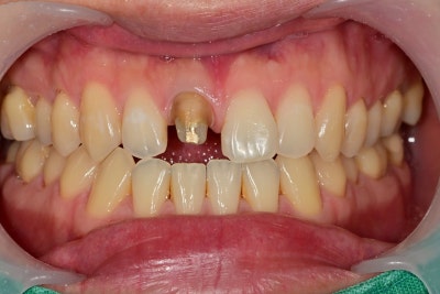 Shingeumho Station Dental Clinic: Concerned about an old, darkened front tooth crown? 사진 5