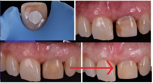 Shingeumho Station Dental Clinic: Concerned about an old, darkened front tooth crown?