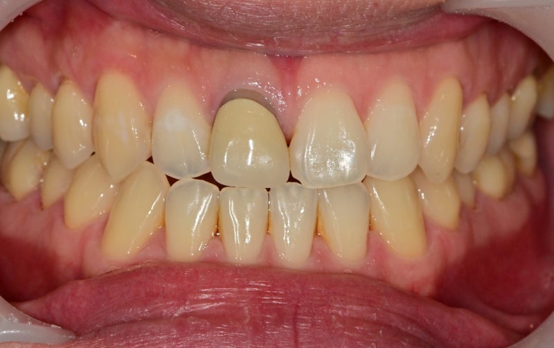 Shingeumho Station Dental Clinic: Concerned about an old, darkened front tooth crown? 사진 2