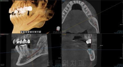 신당역 치과, 임플란트를 수술을 위해 사랑니는 꼭 빼야 하나요?? (얼마나 기다려야 임플란트 치료가 가능한가요?) 사진 7