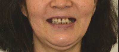 Yaksu-dong Dental Clinic: Recovery Process After Extensive Bone Grafting Implant Surgery 사진 7