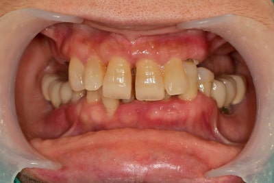 Yaksu-dong Dental Clinic: Recovery Process After Extensive Bone Grafting Implant Surgery 사진 2