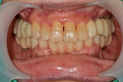 Yaksu-dong Dental Clinic: Recovery Process After Extensive Bone Grafting Implant Surgery 사진 6
