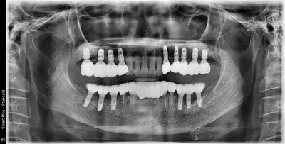 Yaksu-dong Dental Clinic: Recovery Process After Extensive Bone Grafting Implant Surgery 사진 5