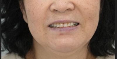 Yaksu-dong Dental Clinic: Recovery Process After Extensive Bone Grafting Implant Surgery 사진 8