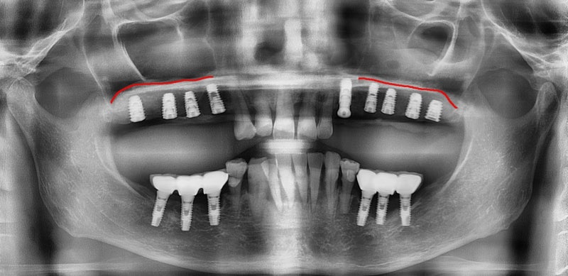 Yaksu-dong Dental Clinic: Recovery Process After Extensive Bone Grafting Implant Surgery 사진 3