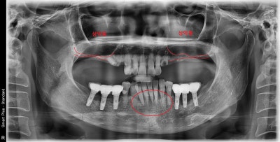 Yaksu-dong Dental Clinic: Recovery Process After Extensive Bone Grafting Implant Surgery