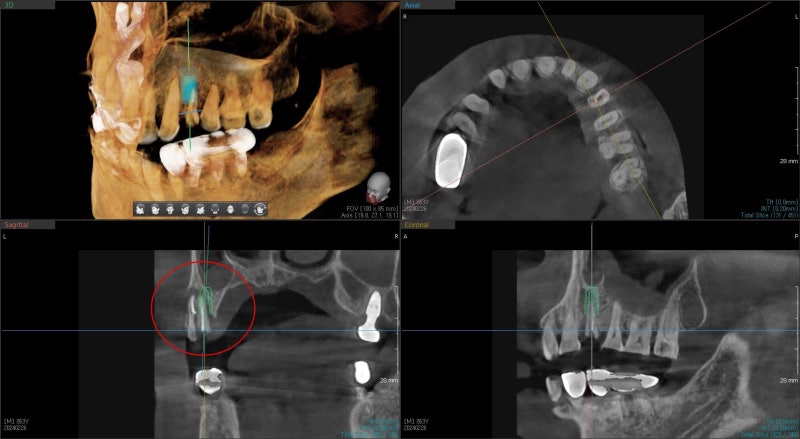 Kumho Station Dental Clinic: When Implant Treatment is Needed After a Fractured (Cracked) Tooth Treatment