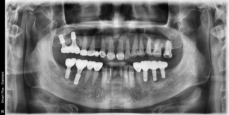 Kumho Station Dental Clinic: When Implant Treatment is Needed After a Fractured (Cracked) Tooth Treatment