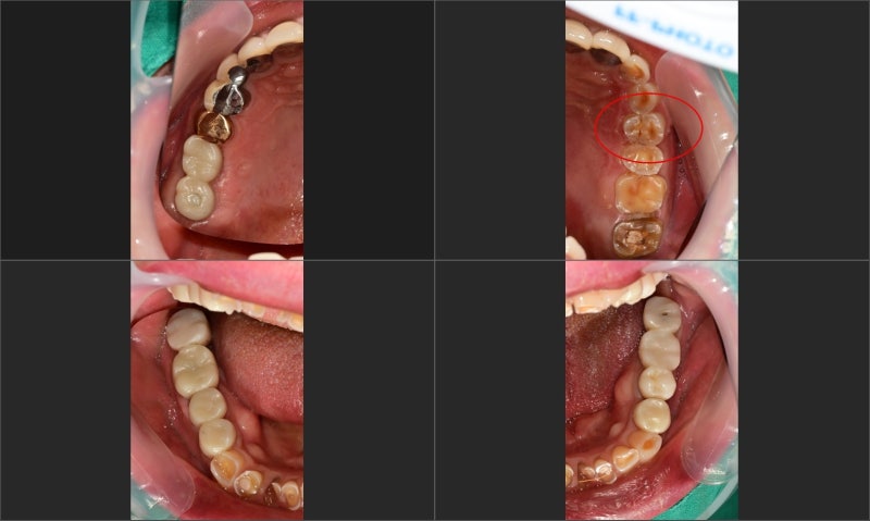Kumho Station Dental Clinic: When Implant Treatment is Needed After a Fractured (Cracked) Tooth Treatment 사진 2