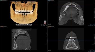 Oksu-dong Dental Clinic: Can Adult Deciduous Teeth Missing Front Teeth Be Restored with Prosthetics or Implants?