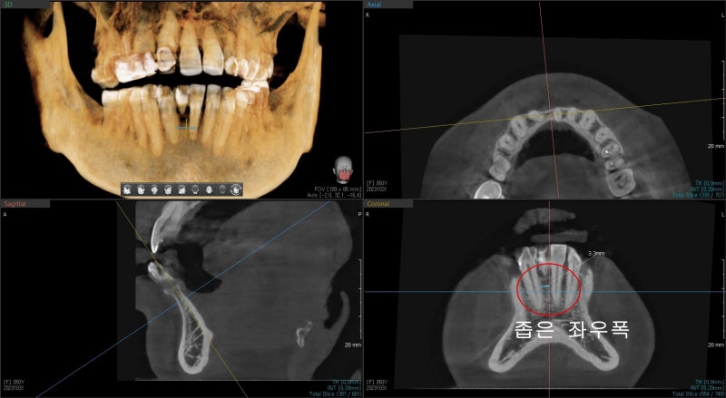 Oksu-dong Dental Clinic: Can Adult Deciduous Teeth Missing Front Teeth Be Restored with Prosthetics or Implants? 사진 3