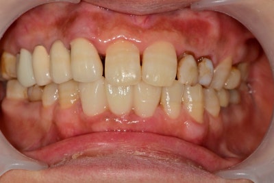 Oksu-dong Dental Clinic: Can Adult Deciduous Teeth Missing Front Teeth Be Restored with Prosthetics or Implants? 사진 5