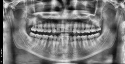 Oksu-dong Dental Clinic: Can Adult Deciduous Teeth Missing Front Teeth Be Restored with Prosthetics or Implants? 사진 7