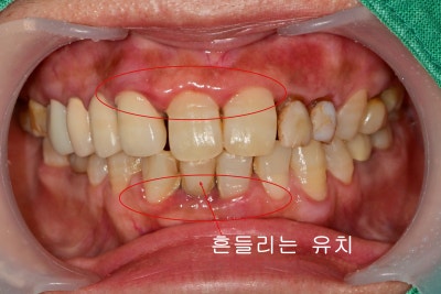 Oksu-dong Dental Clinic: Can Adult Deciduous Teeth Missing Front Teeth Be Restored with Prosthetics or Implants? 사진 2