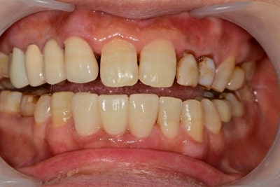 Oksu-dong Dental Clinic: Can Adult Deciduous Teeth Missing Front Teeth Be Restored with Prosthetics or Implants? 사진 6