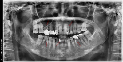 Oksu-dong Dental Clinic: Can Adult Deciduous Teeth Missing Front Teeth Be Restored with Prosthetics or Implants?
