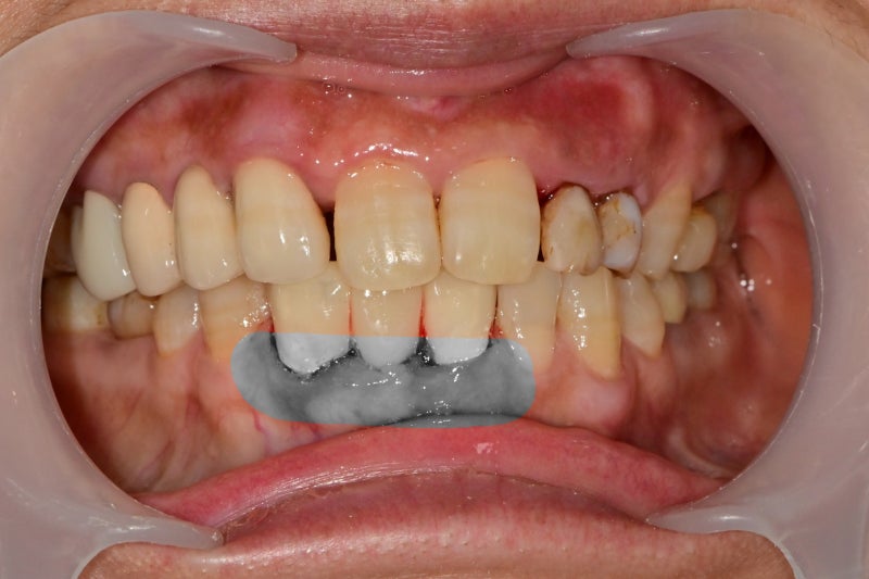 Oksu-dong Dental Clinic: Can Adult Deciduous Teeth Missing Front Teeth Be Restored with Prosthetics or Implants? 사진 4