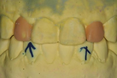 Hannam-dong Dental Clinic: Precautions for Resin Treatment of Gaps Between Front Teeth 사진 3