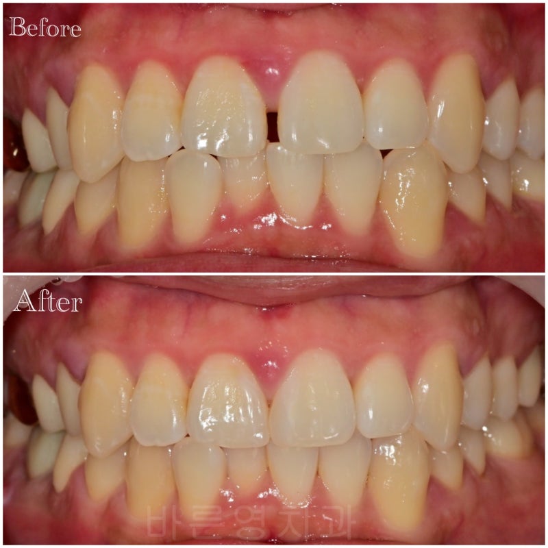 Hannam-dong Dental Clinic: Precautions for Resin Treatment of Gaps Between Front Teeth 사진 5