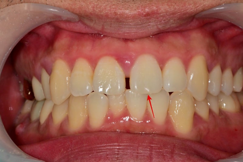 Hannam-dong Dental Clinic: Precautions for Resin Treatment of Gaps Between Front Teeth