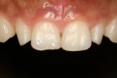 Hannam-dong Dental Clinic: Precautions for Resin Treatment of Gaps Between Front Teeth 사진 2