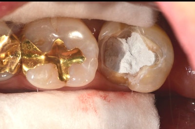 Jangchung-dong Dental Clinic: Precautions for Root Canal Treatment Using MTA (Cracked Teeth, Deep Cavities) 사진 8
