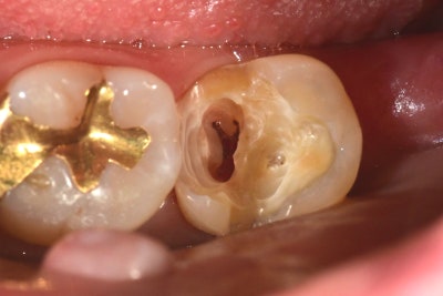Jangchung-dong Dental Clinic: Precautions for Root Canal Treatment Using MTA (Cracked Teeth, Deep Cavities) 사진 7
