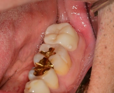 Jangchung-dong Dental Clinic: Precautions for Root Canal Treatment Using MTA (Cracked Teeth, Deep Cavities) 사진 10