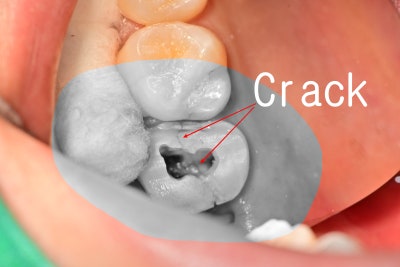 Jangchung-dong Dental Clinic: Precautions for Root Canal Treatment Using MTA (Cracked Teeth, Deep Cavities)