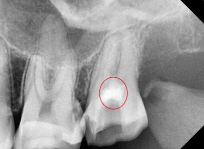 Jangchung-dong Dental Clinic: Precautions for Root Canal Treatment Using MTA (Cracked Teeth, Deep Cavities) 사진 2