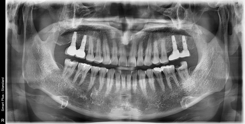 Jangchung-dong Dental Clinic: Precautions for Root Canal Treatment Using MTA (Cracked Teeth, Deep Cavities) 사진 5