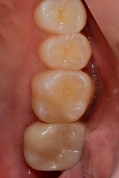 Jangchung-dong Dental Clinic: Precautions for Root Canal Treatment Using MTA (Cracked Teeth, Deep Cavities) 사진 4