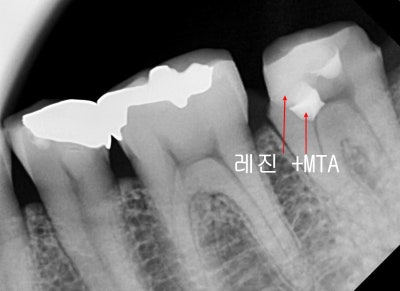Jangchung-dong Dental Clinic: Precautions for Root Canal Treatment Using MTA (Cracked Teeth, Deep Cavities) 사진 9
