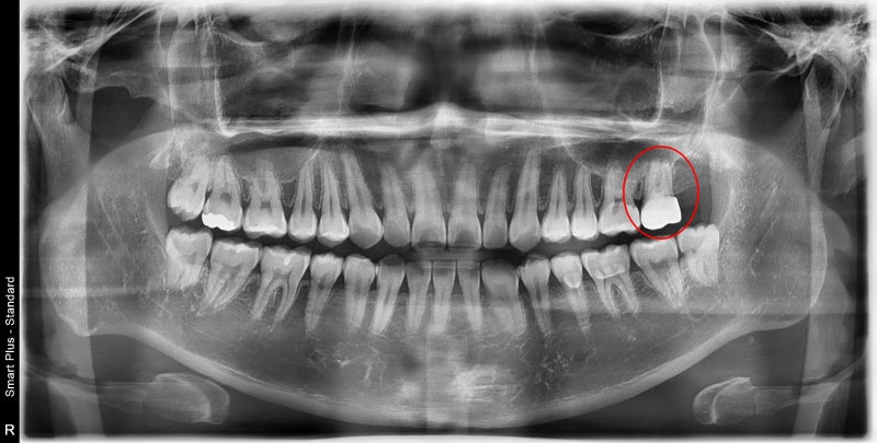 Jangchung-dong Dental Clinic: Precautions for Root Canal Treatment Using MTA (Cracked Teeth, Deep Cavities) 사진 3