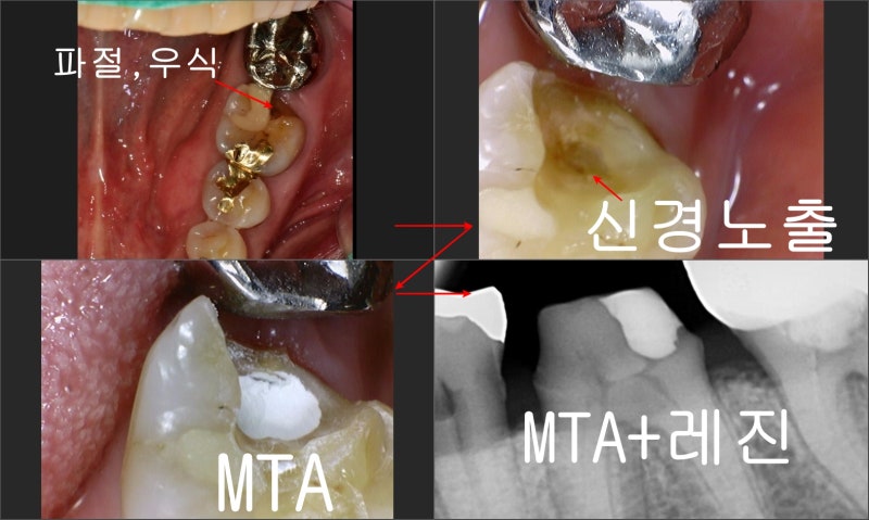 Jangchung-dong Dental Clinic: Precautions for Root Canal Treatment Using MTA (Cracked Teeth, Deep Cavities)