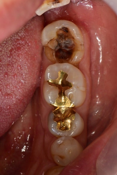 Jangchung-dong Dental Clinic: Precautions for Root Canal Treatment Using MTA (Cracked Teeth, Deep Cavities) 사진 6