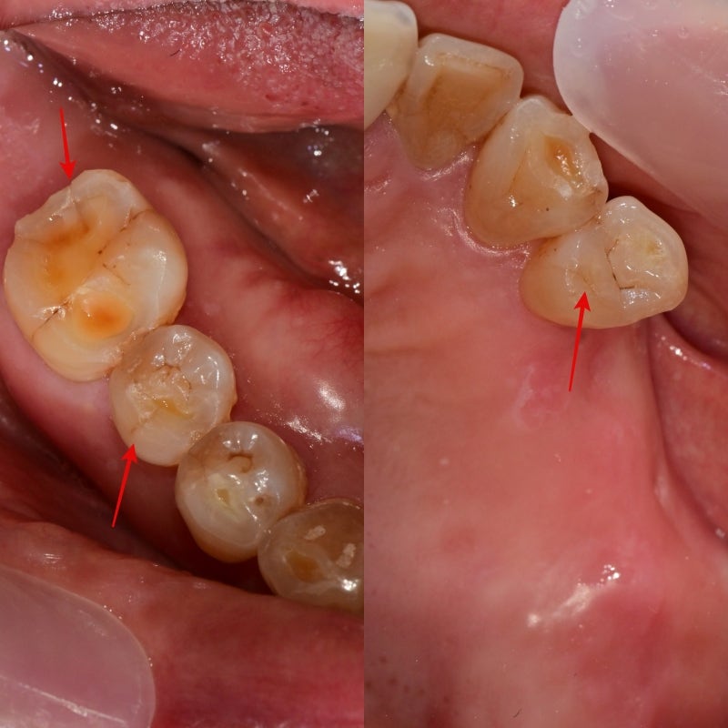 Yaksu Implant: What Causes Sudden Pain When Chewing? 사진 3