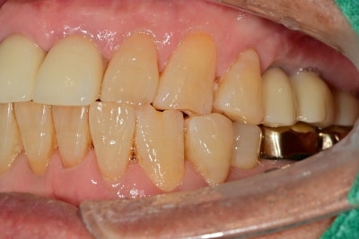 Yaksu Implant: What Causes Sudden Pain When Chewing? 사진 8
