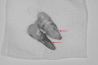 Yaksu Implant: What Causes Sudden Pain When Chewing? 사진 5