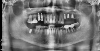 Yaksu Implant: What Causes Sudden Pain When Chewing?